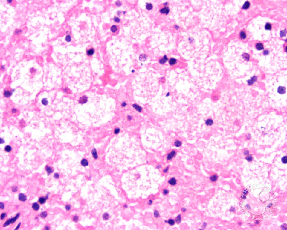 zevra-cashes-in-on-first-fda-approved-npc-treatment-with-prv