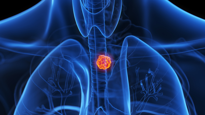 unlocking-the-mystery-behind-barrett’s-esophagus