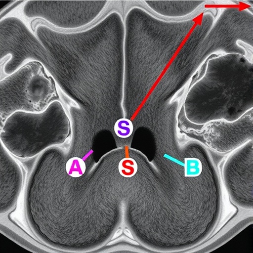 meningioma-subgroup-linked-to-fos,-fosb-fusions