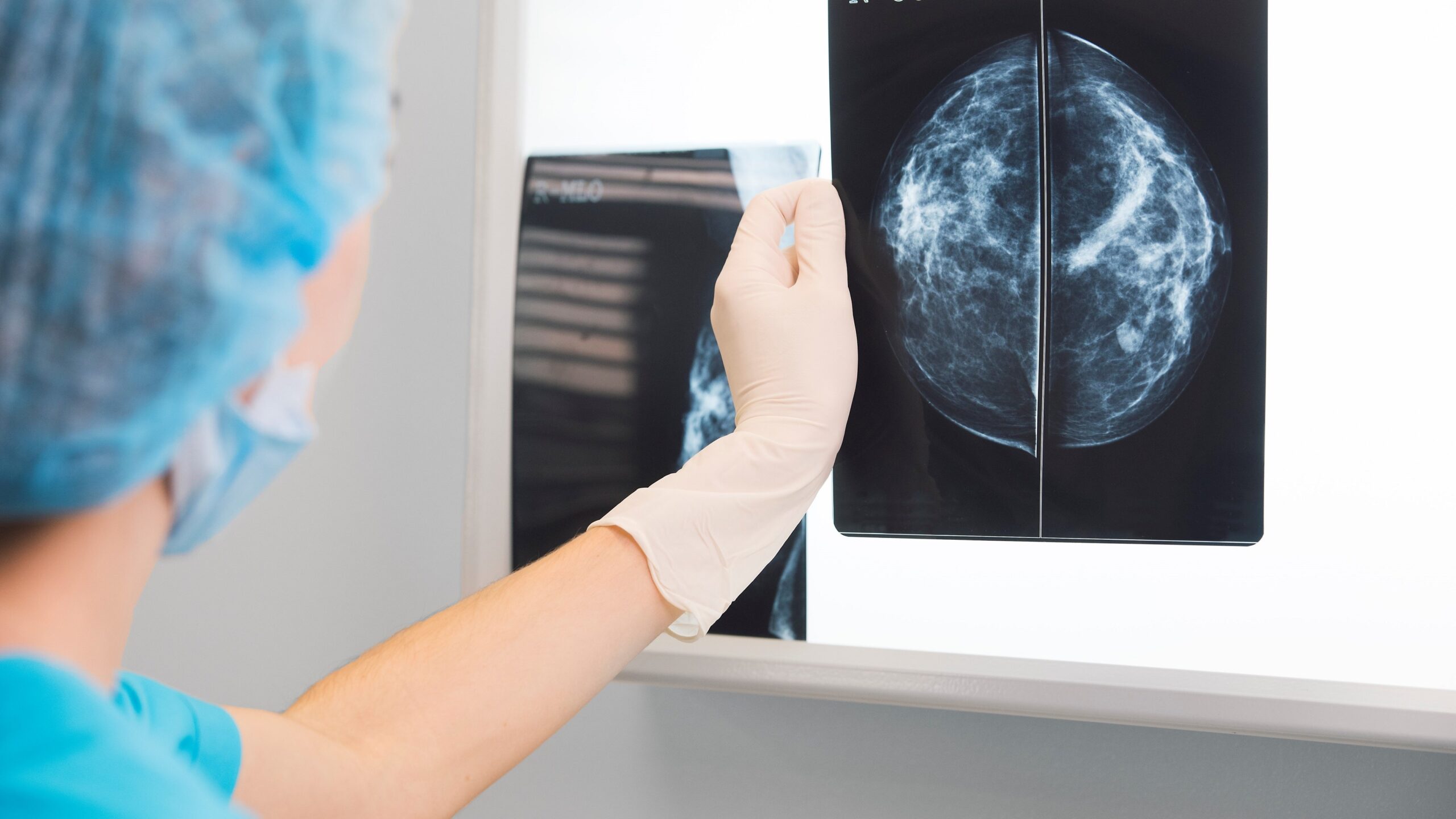 ai-could-help-spot-heart-disease-in-routine-breast-mammogram-screenings