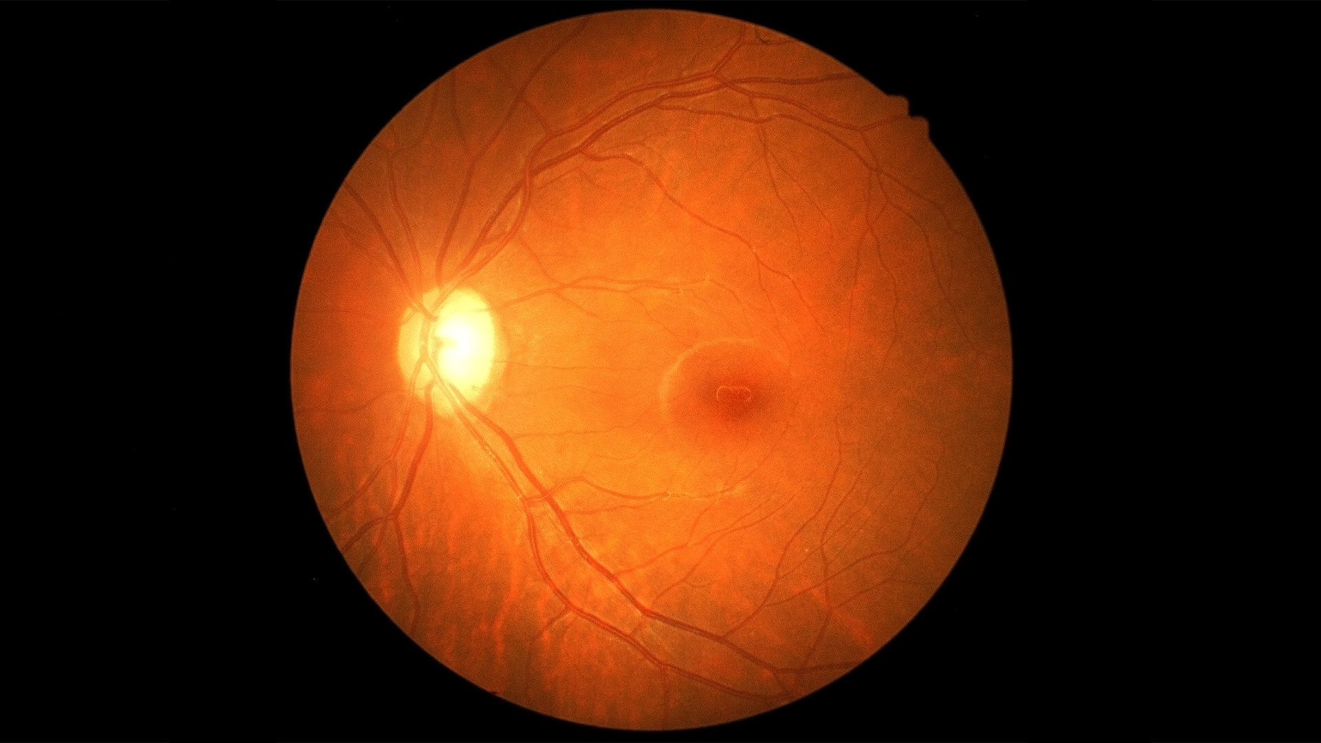 verana-health-enhances-world-renowned-rwd-ophthalmic-registry-with-images